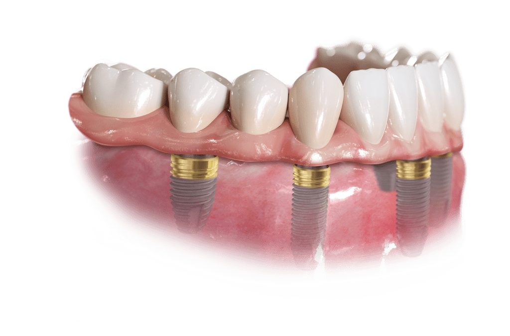 dentures in edmonton ab