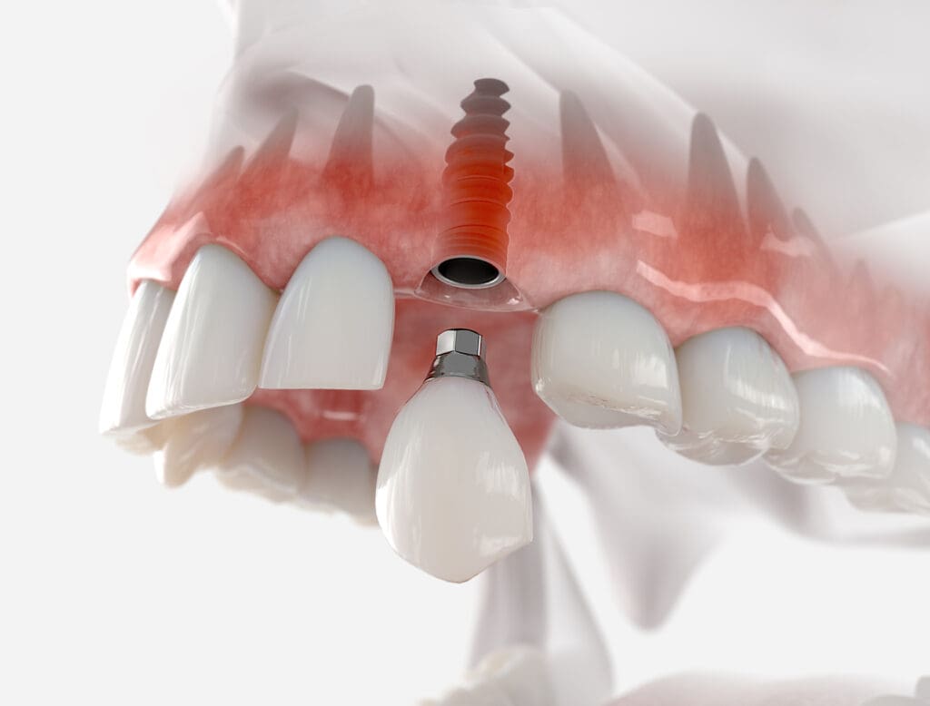 dental implants edmonton ab