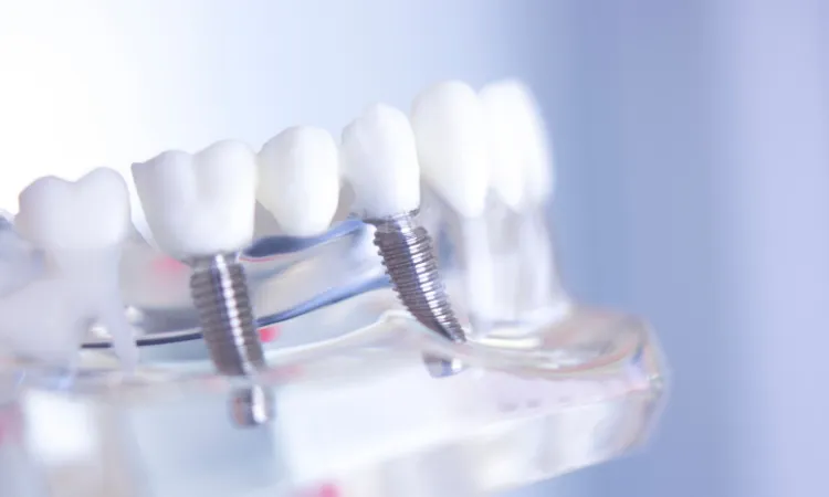Dental Bridges vs. Dental Implants Edmonton AB