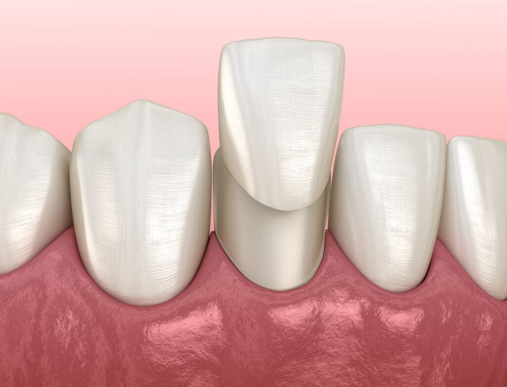 Dental Veneers in Edmonton AB